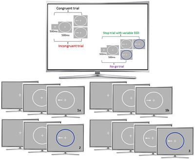 Stop What You're Doing!—An fMRI Study on Comparisons of Neural Subprocesses of Response Inhibition in ADHD and Alcohol Use Disorder